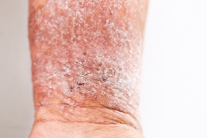 picture of severe Eczema