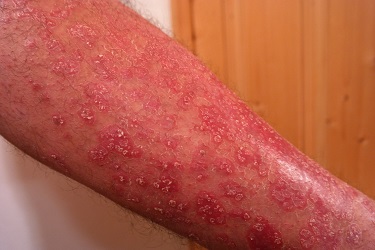 picture of severe psoriasis